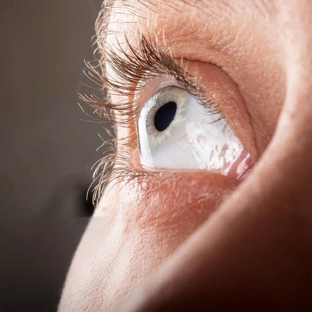 Keratoconus Treatment