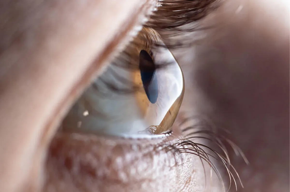 Keratoconus Eye Condition Close-Up View